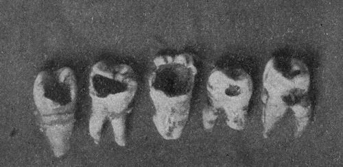 Bad teeth