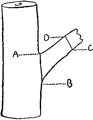 When a broken stump, such as is
here shown, has to be sawn off, the
proper place to amputate it is from A
to B; the wrong place from C to D.