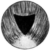 Iridotomy by Ziegler&rsquo;s Method