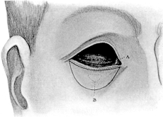 Maxwell&rsquo;s Operation for Contracted Socket