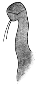 Fergus&rsquo;s Operation for Slight Ectropion of the Lower Lid