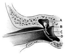 Removal of the Malleus by Wilde&rsquo;s Snare