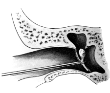 Removal of the Malleus by Wilde&rsquo;s Snare