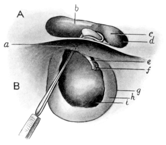 Removal of Incus by Zeroni&rsquo;s Hook