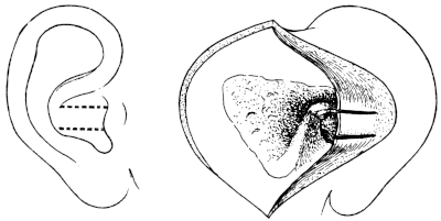 Körner&rsquo;s Post-meatal Flap