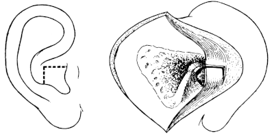 Stacke&rsquo;s Post-meatal Flap
