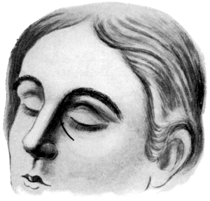 Killian&rsquo;s Operation upon the Frontal Sinus